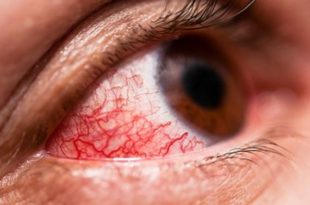 Sore eyeball and headache