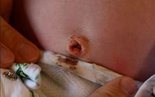 Belly button discharge can cause irritation and even infection