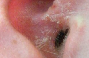 Dry skin in ears