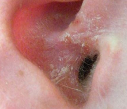 Dry skin in ears