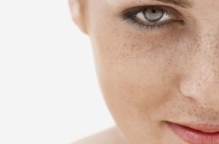 How to get rid of freckles fast