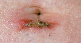 Itchy belly button due to infections