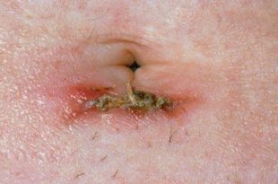 Itchy belly button due to infections