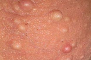 Rash on testicles or rash on scrotum balls