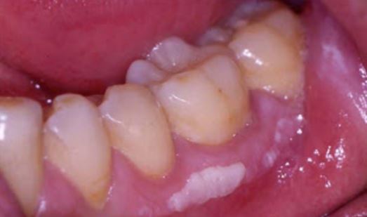 White patches on gums pictures