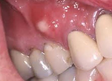 white-spots-on-gums