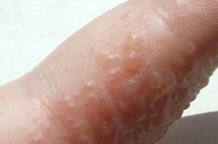 Itchy bumps on fingers small