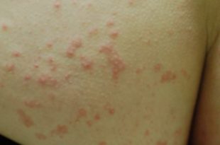 Red rash on buttocks from fungal infections