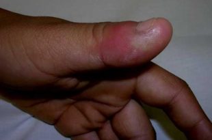 Swollen thumb causes and treatment