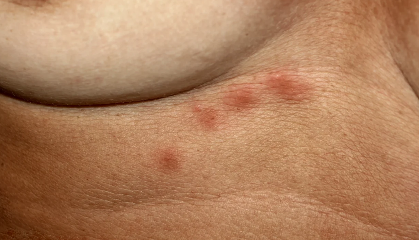 red-spots-on-breast-skin