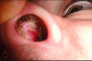 An irritated itchy inside nose or nasal lining