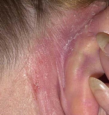 dry-skin-in-ears-can-also-make-them-itch