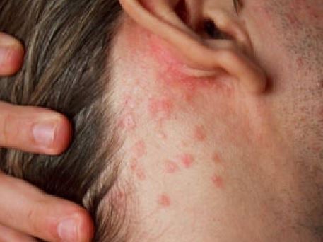 eczema-dermatitis-and-psoriasis-can-cause-an-itchy-outer-ear