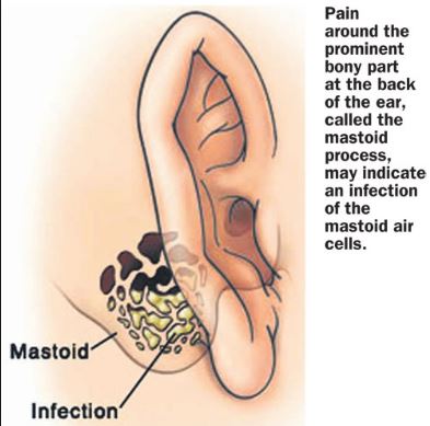 Mastoiditis can cause pain behind ears