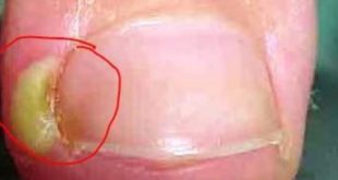 Ingrown toenail pus