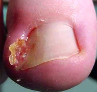 Ingrown toenail pus coming out