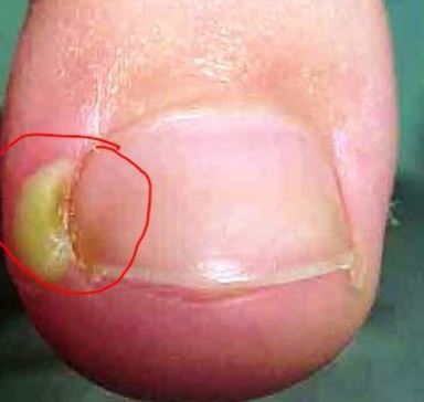 Ingrown toenail pus