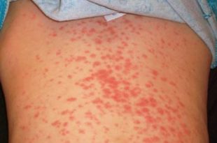 Side effects of amoxicillin - allergic reaction rash