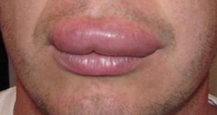 Swollen lip