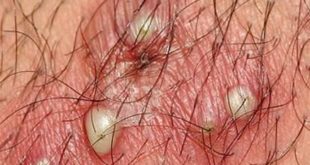 White bumps on scrotum