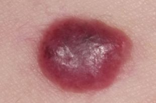blood blister on breast