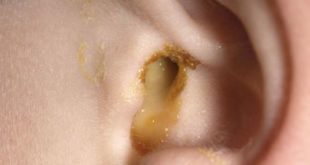 ear drainage
