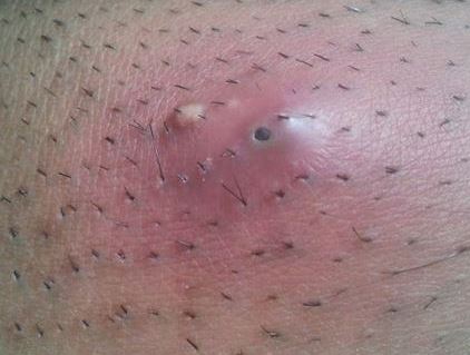 Ingrown hair bump between thihgs