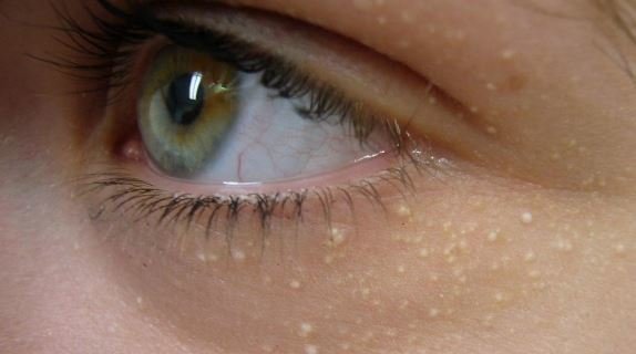 why-whiteheads-on-eyelid-upper-lower-rim-getting-rid-of-bumps