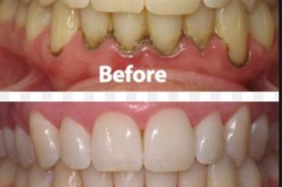 Before and after apple cider vinegar teeth whitening