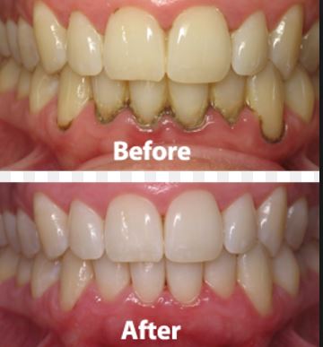 Before and after apple cider vinegar teeth whitening