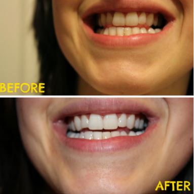 Before and after pictures turmeric teeth whitening