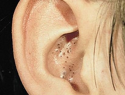 Blackheads inside ear canal