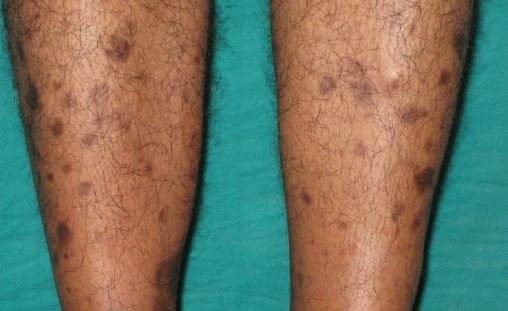 Brown Spots on Legs, Lower Legs, Get Rid of Little Light 