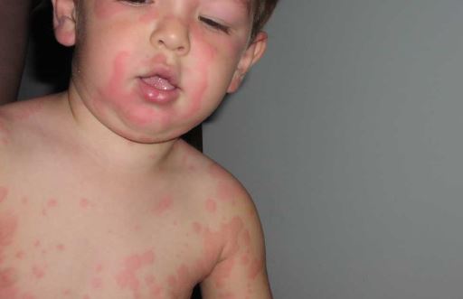 Chlorine rash pictures in babies after swimming