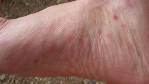 Itchy bumps on feet