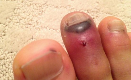 Pictures of blood blisters o toes