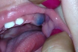 Purple gums 1