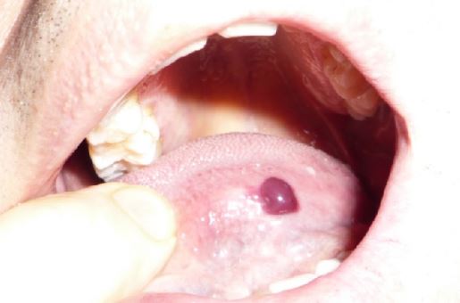 Tongue biting can also lead to red blisters