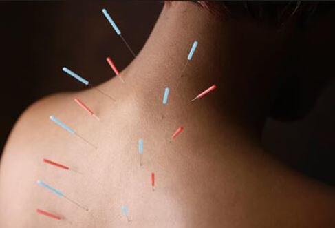 Acupuncture is said to help relieve pain and anxiety