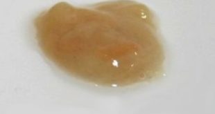 Coughing up brown mucus or phlegm