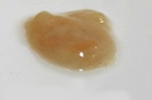 Coughing up brown mucus or phlegm