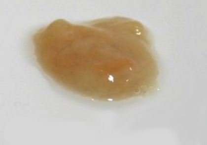 Coughing up brown mucus or phlegm