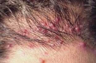 Folliculitis may also cause ingrown hair on your scalp