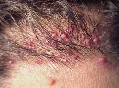 Folliculitis may also cause ingrown hair on your scalp