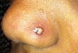 Infected nose piercing signs