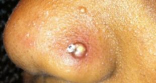 Infected nose piercing signs