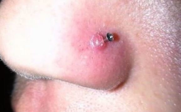 Infected nose piercing bump