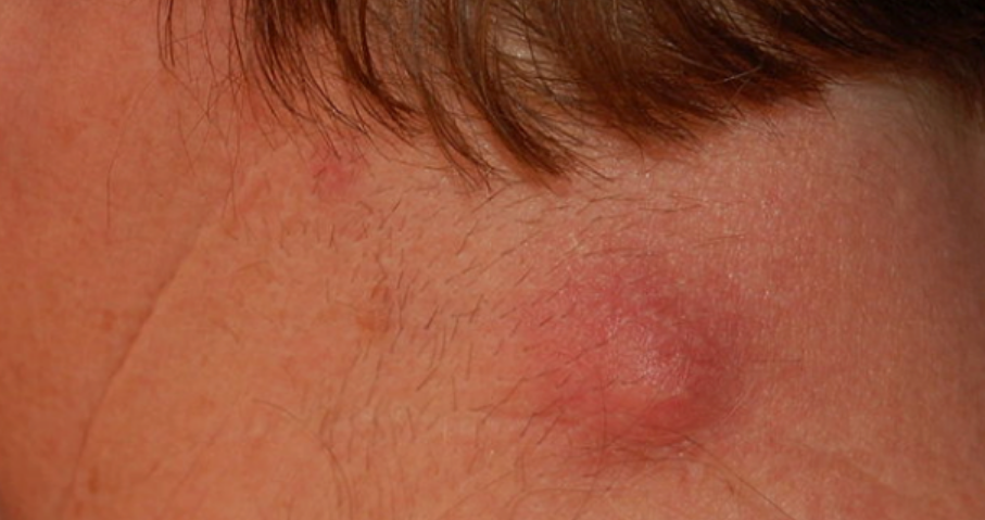Infected sebaceous cyst