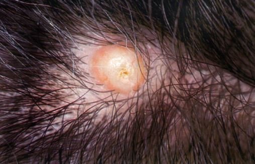 Ingrown hair cyst on scalp